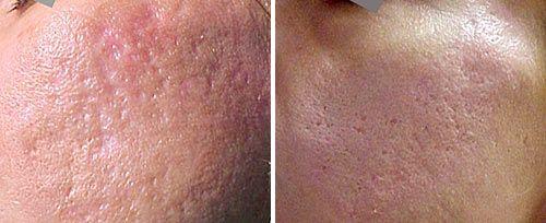 <h4>Acne Scars Treatment</h4>Courtesy of: Giuseppe Ivano Luppino, M.D.<br>Laser source: Er:YAG (2940 nm)