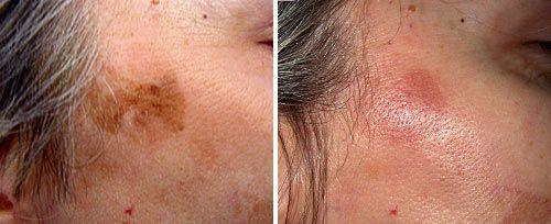 <h4>Actinic Keratosis Treatment</h4>Courtesy of: Giuseppe Ivano Luppino, M.D.<br>Laser source: Q-Switched Nd:YAG (1064 nm)