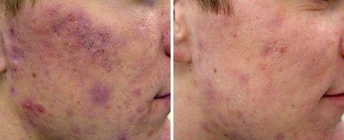 <h4>Active Acne Treatment</h4>Courtesy of: Robin Sult, R.N.<br>Laser source: Nd:YAG (1064 nm)