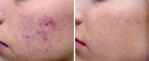 <h4>Active Acne Treatment</h4>Courtesy of: Robin Sult, R.N.<br>Laser source: Nd:YAG (1064 nm)