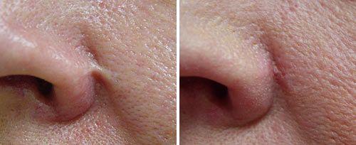 <h4>Nasal Scar Treatment</h4>Courtesy of: Robin Sult, R.N.<br>Laser source: Er:YAG (2940 nm)