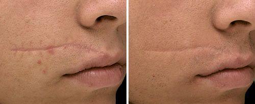 <h4>Facial Scar Treatment</h4>Courtesy of: Jasmina Kozarev, M.D., PhD.<br>Laser source: Er:YAG (2940 nm)